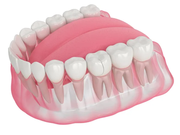 3d renderização da mandíbula com dente fraturado — Fotografia de Stock