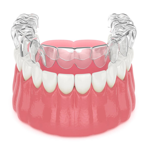 3d render of invisalign removable and invisible retainer with lower jaw over white background