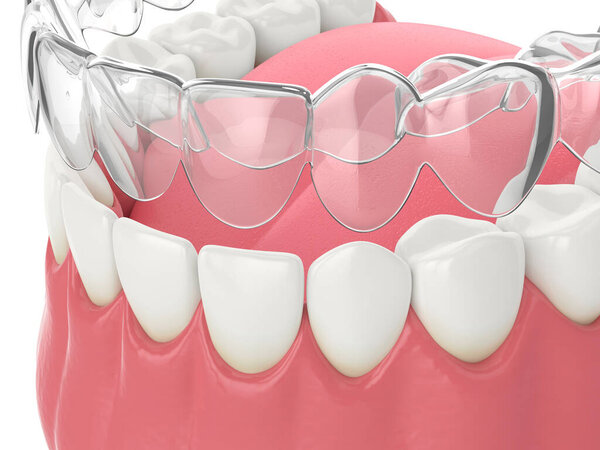 3d render of invisalign removable and invisible retainer with lower jaw over white background