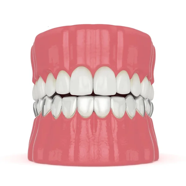 Render Invisalign Removable Invisible Retainer Lower Jaw White Background — Stock Photo, Image
