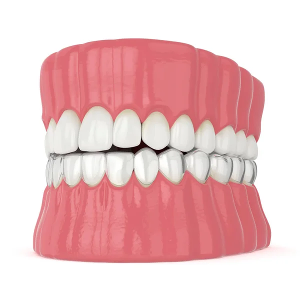 Render Invisalign Removable Invisible Retainer Lower Jaw White Background — Stock Photo, Image