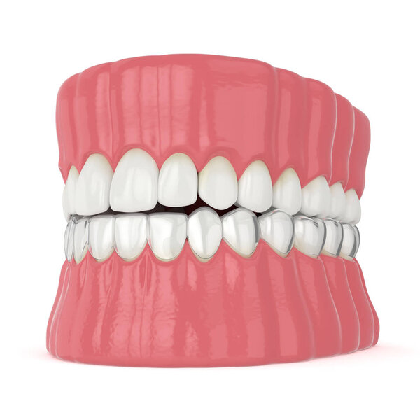 3d render of invisalign removable and invisible retainer with lower jaw over white background