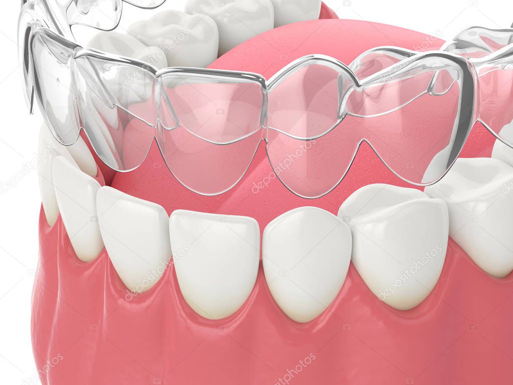 3d render of invisalign removable and invisible retainer with lower jaw over white background