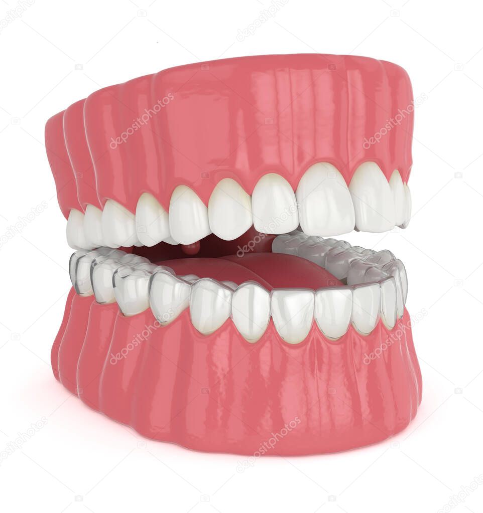 3d render of jaw with invisalign removable retainer over white background