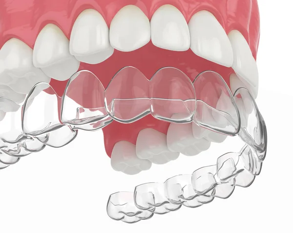 Render Upper Jaw Invisalign Removable Retainer White Background — Stock Photo, Image
