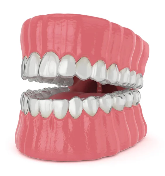 Render Jaw Invisalign Removable Retainers White Background — Stock Photo, Image
