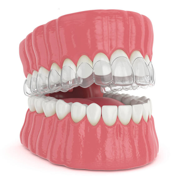 3d render of jaw with invisalign removable retainer over white background