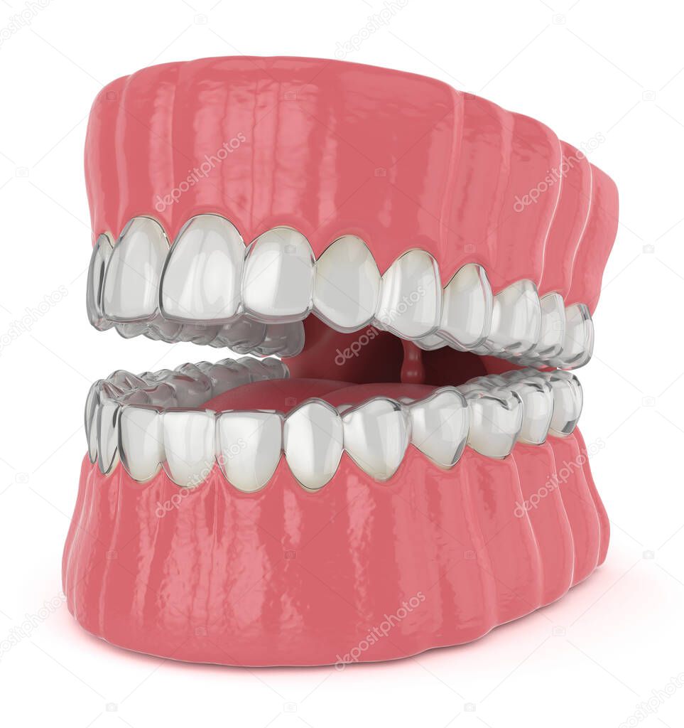 3d render of jaw with invisalign removable retainers over white background