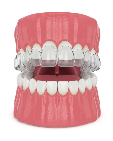 3Dレンダリングの顎とともにInvisaligne取り外し可能なリテーナー上白い背景 — ストック写真