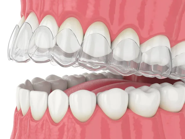 Renderização Invisalign Retentor Removível Invisível Mandíbula Sobre Fundo Branco — Fotografia de Stock