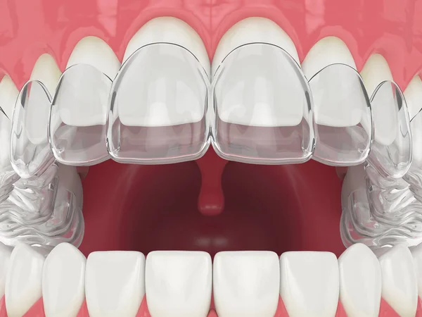 Rendu Mâchoire Avec Invisalign Supérieure Amovible Retenue — Photo