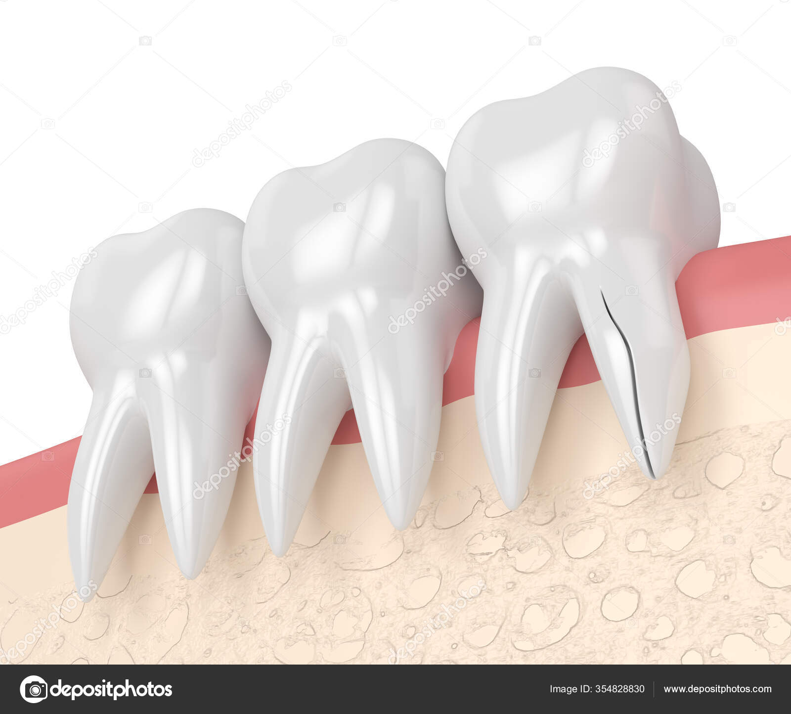 30ml Resin Temporary Tooth Repair Granules Teeth Gaps Missing Broken Tooth  False Teeth Filling Moldable Solid Glue Dental Care - AliExpress