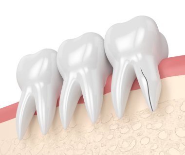 Beyaz arka planda kırık diş köküne sahip 3 boyutlu diş eti. Dikey kırık. Kırık diş kavramının farklı türleri.