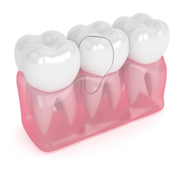 Καθιστούν Της Γνάθου Ιάσιμο Ραγισμένο Δόντι Πάνω Από Λευκό Φόντο — Φωτογραφία Αρχείου