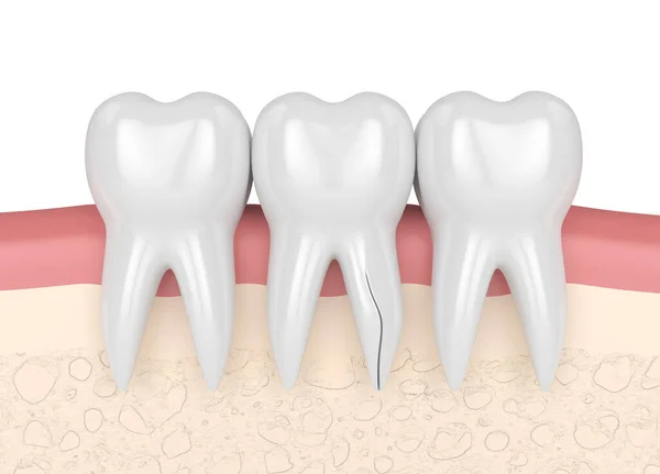 Rendering Gengive Con Radice Dente Incrinata Sfondo Bianco Frattura Verticale — Foto Stock