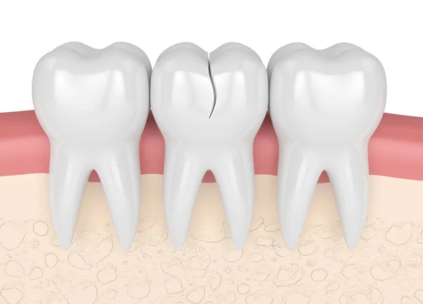 Render Gums Treatable Cracked Tooth White Background Different Types Broken — Stock Photo, Image