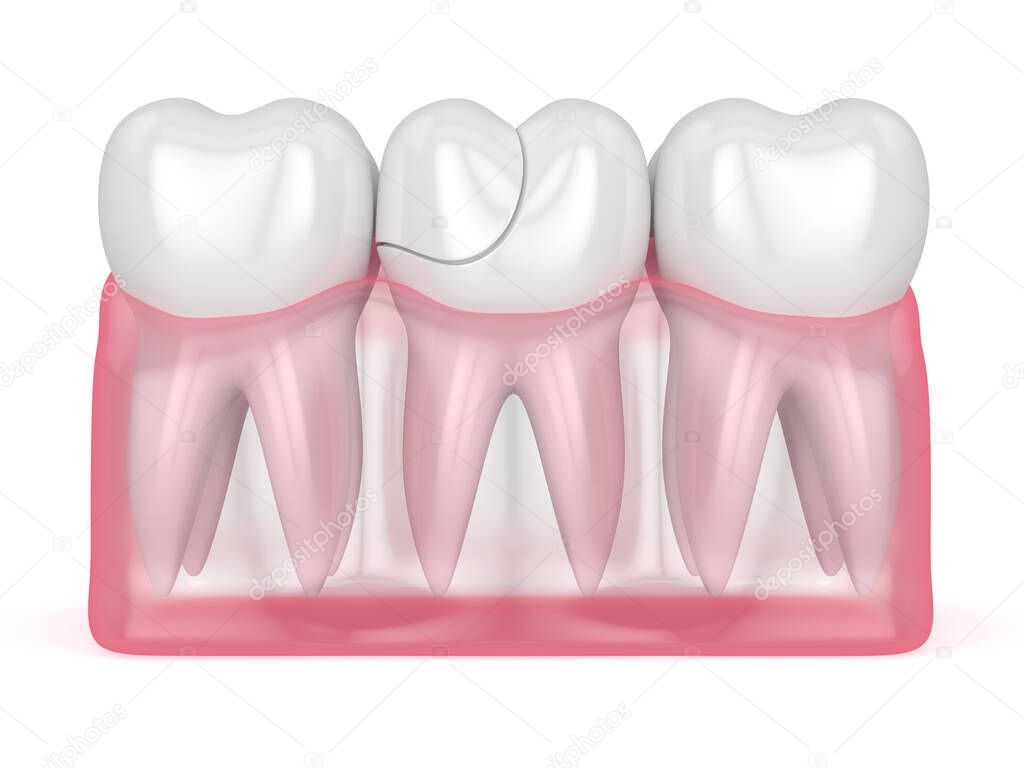 3d render of translucent gums with cracked tooth over white background. Fractured cusps. Different types of broken teeth concept.