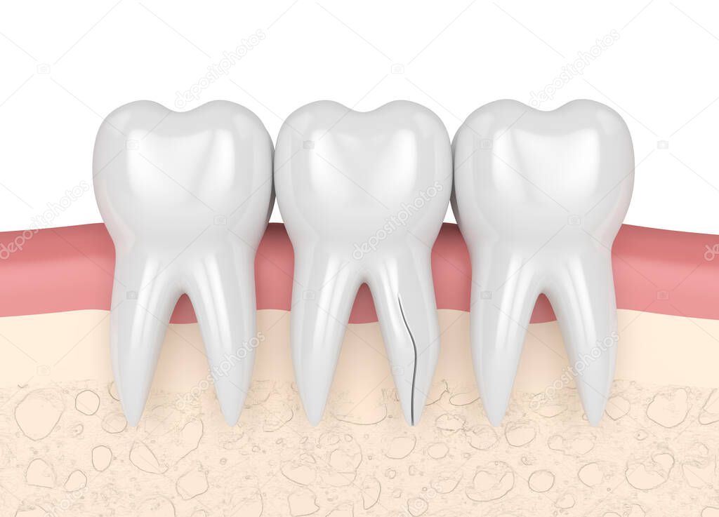 3d render of gums with cracked tooth root over white background. Vertical fracture. Different types of broken teeth concept.