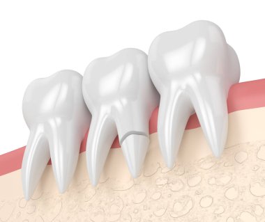 Beyaz arka planda kırık diş köküne sahip 3 boyutlu diş eti. Kırık diş kavramının farklı türleri.