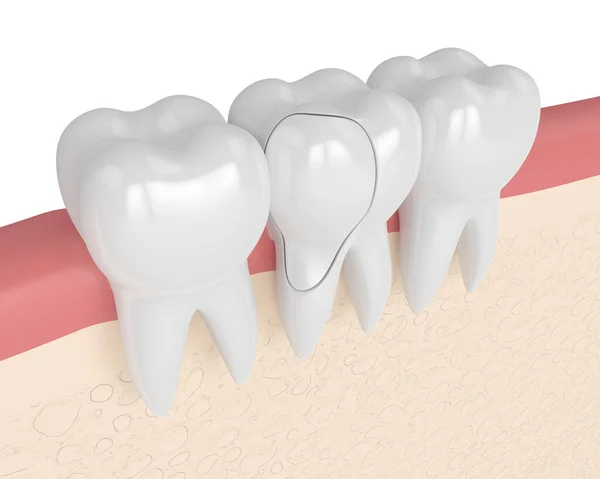 Render Gums Treatable Cracked Tooth White Background Fractured Cusps Different — Stock Photo, Image