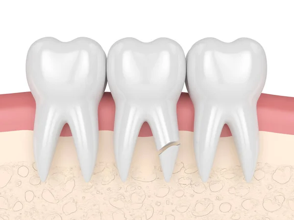 白い背景に割れた歯根を持つ歯茎の3Dレンダリング 壊れた歯の概念の異なる種類 — ストック写真