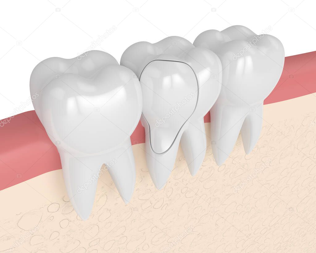 3d render of gums with treatable cracked tooth over white background. Fractured cusps. Different types of broken teeth concept.