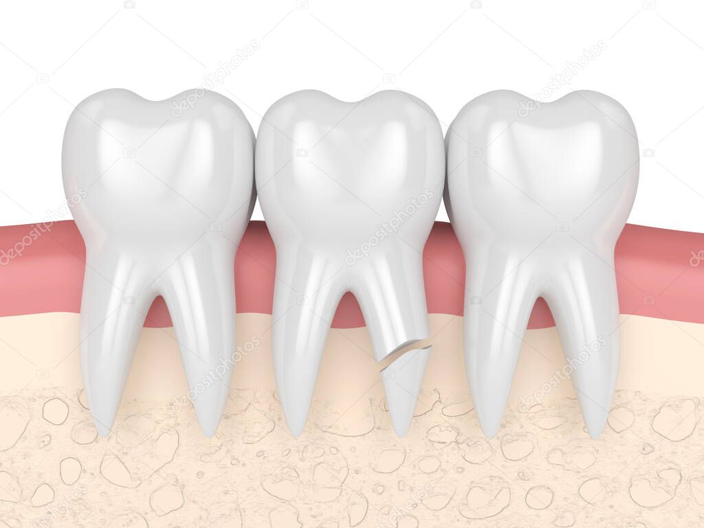 3d render of gums with cracked tooth root over white background. Different types of broken teeth concept.