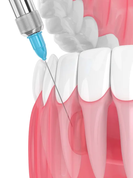 假牙麻醉下颌骨和注射器的3D渲染 牙科治疗概念 — 图库照片