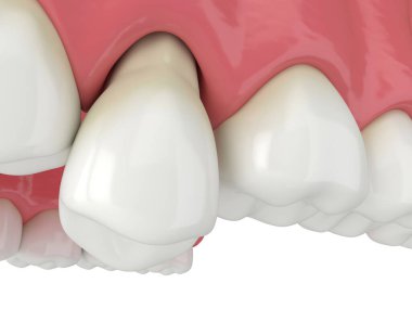Diş etlerinden çıkan dişle 3d çene oluşturma