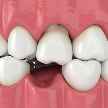 3 boyutlu çene yapısı ve diş çıkıntısı olan kök. Düşük diş kaybının sonuçları.