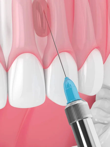 假牙麻醉下颌骨和注射器的3D渲染 牙科治疗概念 — 图库照片