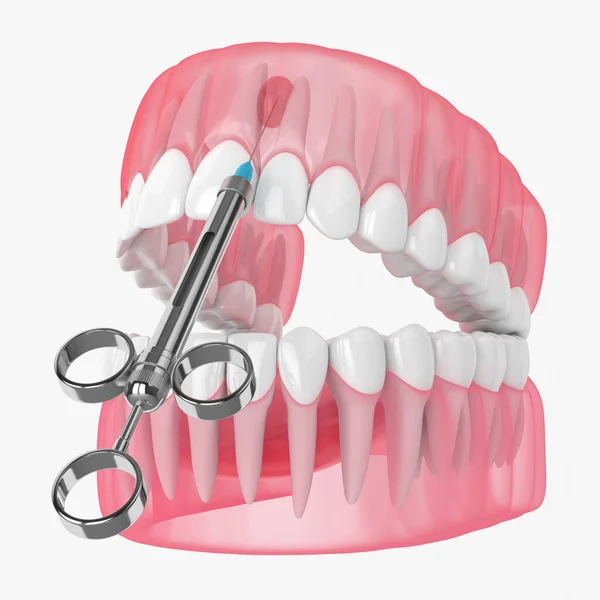 Renderizado Mandíbula Jeringa Con Anestesia Dental Concepto Tratamiento Dental — Foto de Stock