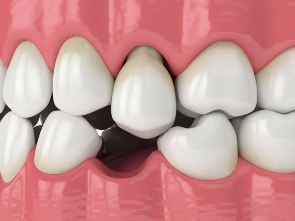 根を明らかに突き出た歯を持つ顎の3Dレンダリング 歯のギャップを埋めるために欠けて歯の領域に向けてスライドします 歯の損失の結果 — ストック写真