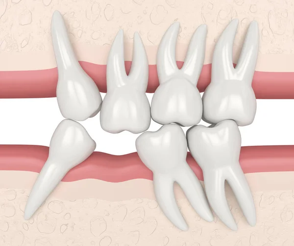 3d render of teeth sliding towards the area of missing tooth in order to fill the gap. Consequences of lower tooth loss.