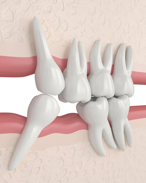 Renderizado Dientes Deslizándose Hacia Área Diente Faltante Con Fin Llenar — Foto de Stock