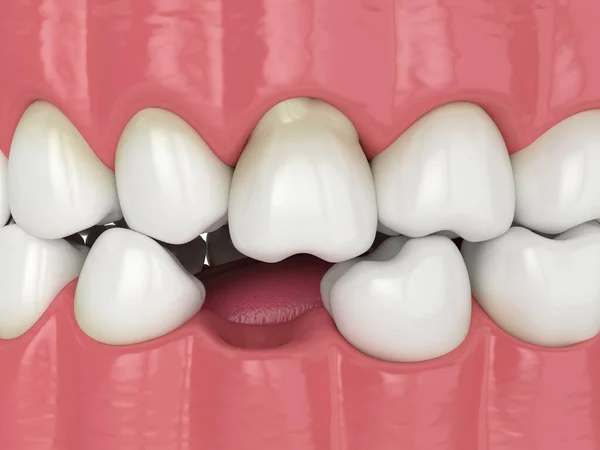 3d render of teeth sliding towards the area of missing tooth in order to fill the gap. Consequences of lower tooth loss.