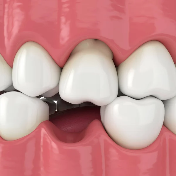 Renderowanie Szczęki Wystającym Zębem Odsłaniającym Korzeń Konsekwencje Mniejszej Utraty Zęba — Zdjęcie stockowe