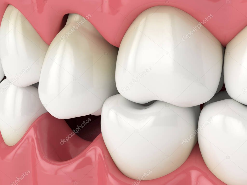 3d render of jaw with protruding tooth revealing root. Consequences of lower tooth loss.