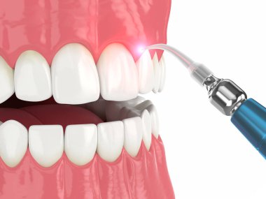 Diş etlerinin tedavisinde kullanılan 3 boyutlu diyot lazer. Diş etlerinin tedavisinde lazer tedavisi kavramı