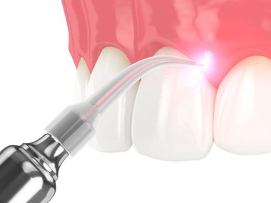 Diş etlerinin tedavisinde kullanılan 3 boyutlu diyot lazer. Diş etlerinin tedavisinde lazer tedavisi kavramı