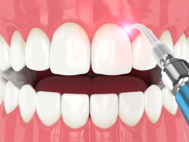 3d render of dental diode laser used to treat gums. The concept of using laser therapy in the treatment of gums clipart