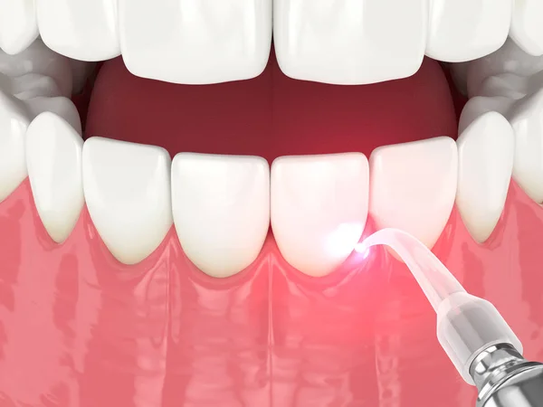 3d render of dental diode laser used to treat gums. The concept of using laser therapy in the treatment of gums