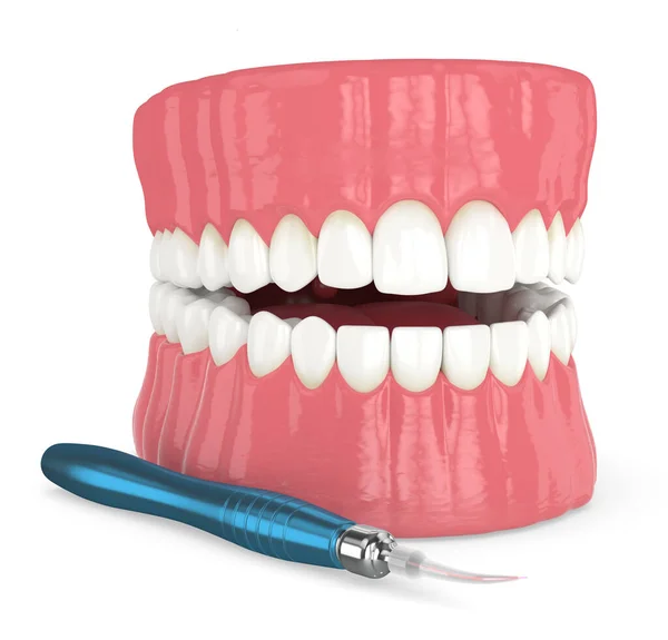 3d render of dental diode laser used to treat gums. The concept of using laser therapy in the treatment of gums