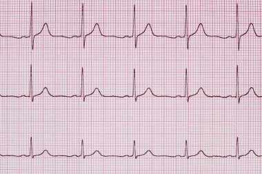 Yazdırılan EKG dalgalar