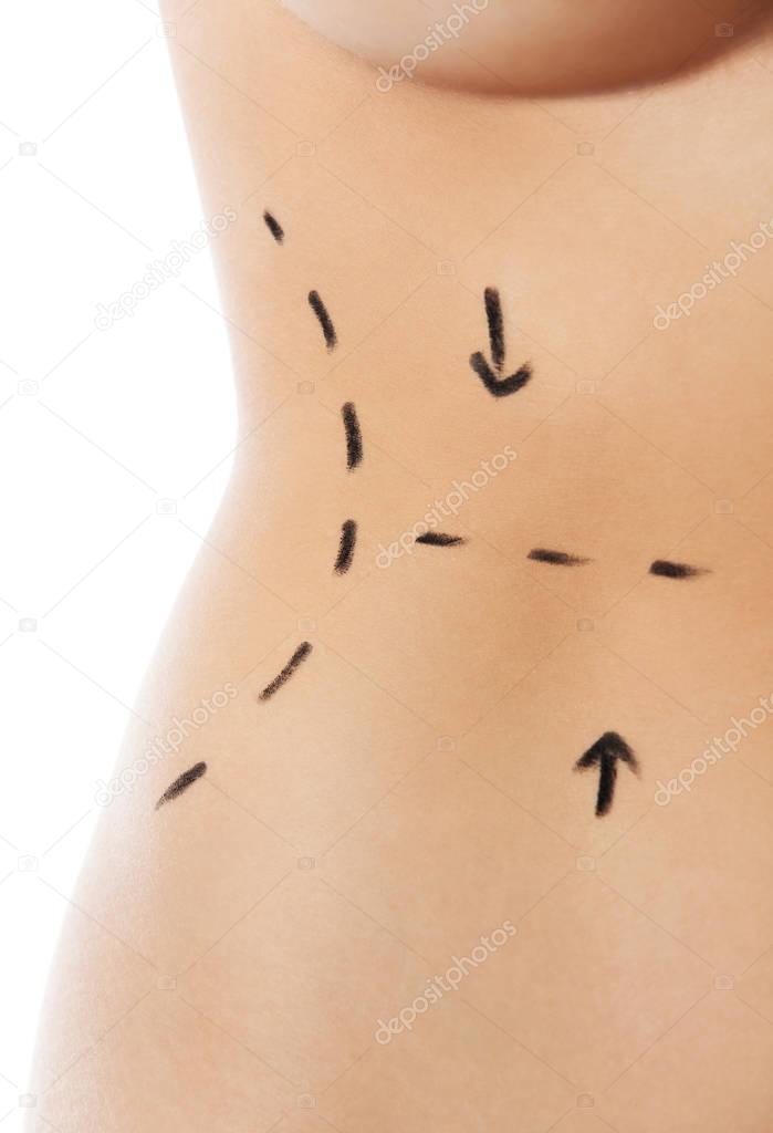 Woman body marked out for cosmetic surgery.