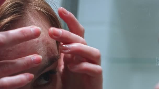 Frau mit Akne auf der Stirn — Stockvideo