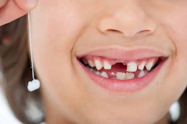 Jovem Menino Perdeu Seu Dente — Fotografia de Stock