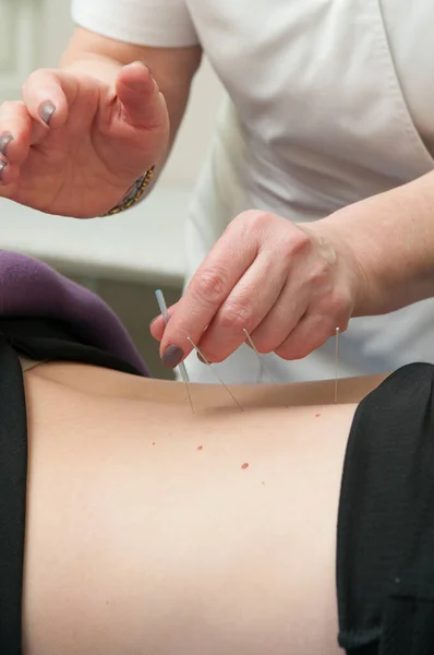 Bir Kadının Akupunktur Tedavisi Görmesi — Stok fotoğraf