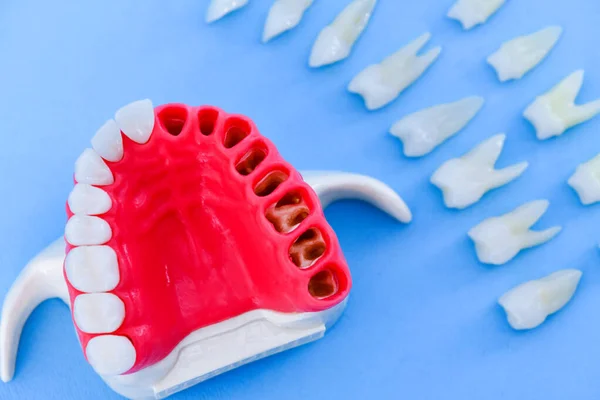 Proceso de instalación de implantes dentales y corona —  Fotos de Stock