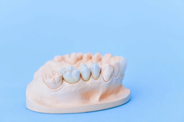 Modelo de yeso de la mandíbula humana —  Fotos de Stock
